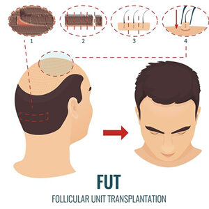 Hair Transplant in Raipur, Hair Fall Treatment at Best Cost in Raipur