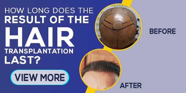 How Long Does the Result of the Hair Transplantation Last?