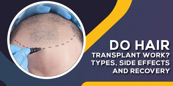Do Hair Transplant Work? Types, Side Effects And Recovery