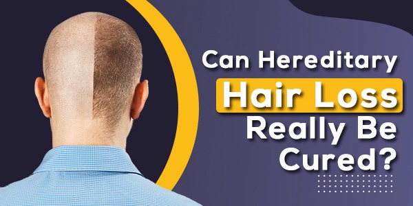 Can Hereditary Hair Loss Really Be Cured?