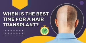 When Is The Best Time For a Hair Transplant?