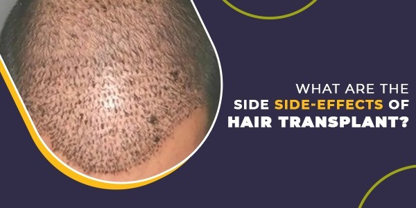 What are the Side-Effects of Hair Transplant?