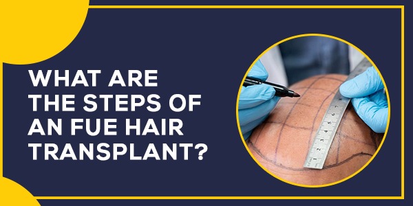 What Are The Steps Of An FUE Hair Transplant?