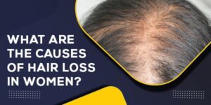 What Are The Causes Of Hair Loss In Women (2)
