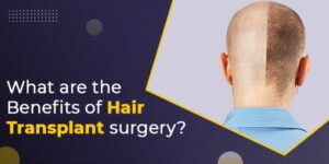 benefits-of-hair-transplant-surgery