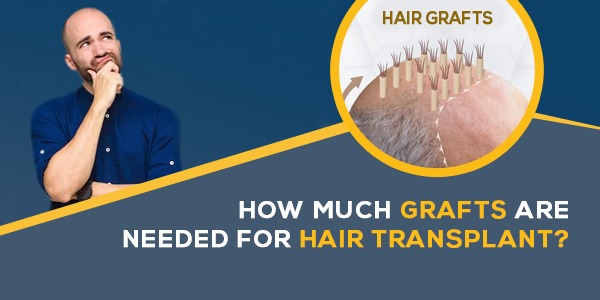 How Much Grafts Are Needed For Hair Transplant?