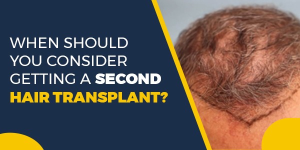 When Should You Consider Getting a Second Hair Transplant?