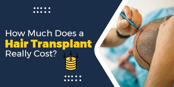 How Much Does a Hair Transplant Really Cost?