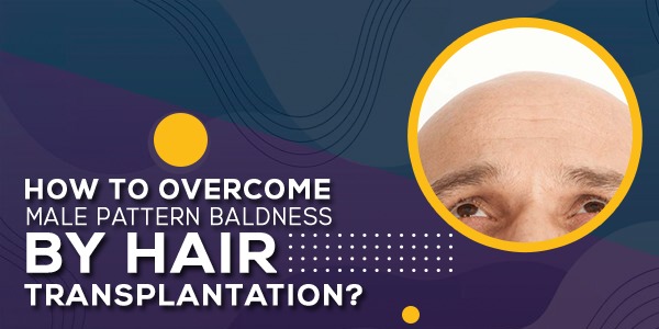 How To Overcome Male Pattern Baldness By Hair Transplantation?