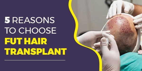 5 Reasons to Choose FUT Hair Transplant