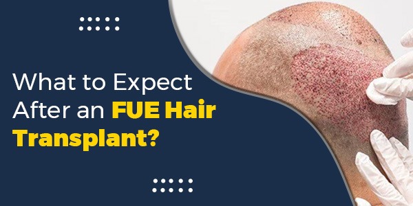 What to Expect After an FUE Hair Transplant?