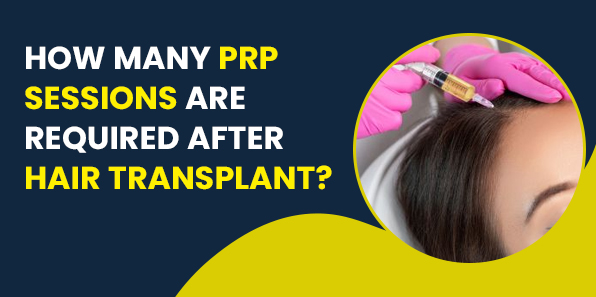 How Many PRP Sessions Are Required After Hair Transplant?