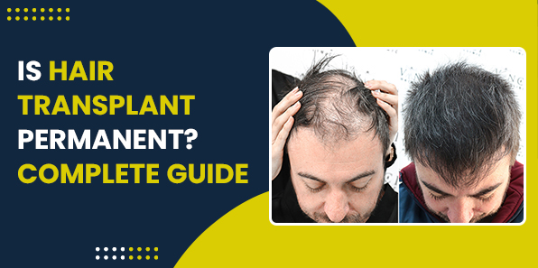 Is Hair Transplant Permanent? Complete Guide
