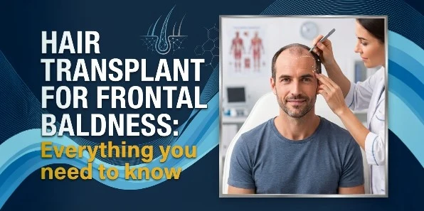 Hair Transplant for Frontal Baldness: Everything You Need to Know